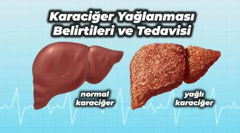 Karaciğer Yağlanması: Limon Suyuyla Geçer Mi?