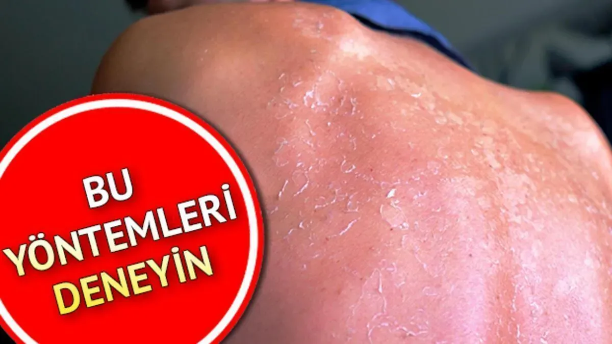 Güneş Yanığı ile Melanom Riski: Uzmanlardan Uyarılar