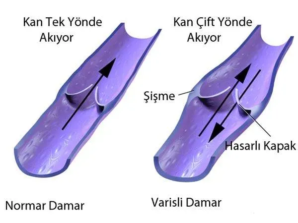 Varisli Damarlar ve Bunama: Riskleri Anlayın