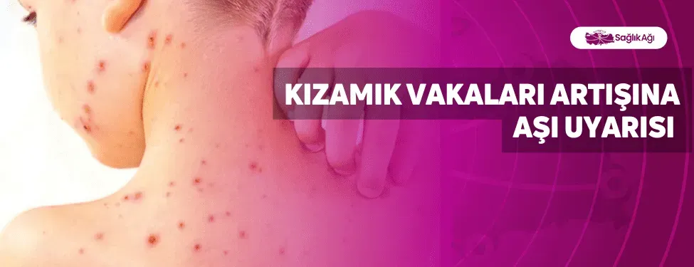 Kızamık Vakaları Arttı: DSÖ Uyarıyor