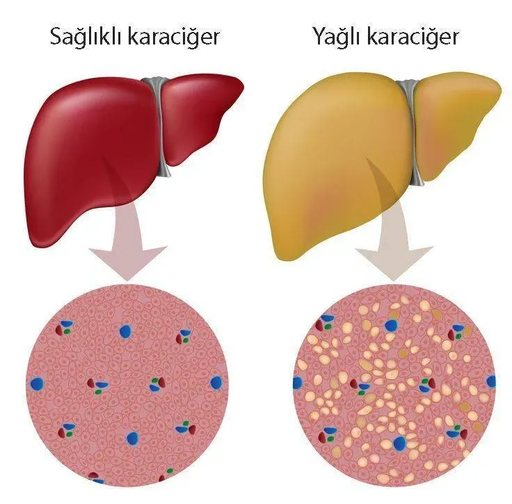 Alkolsüz Yağlı Karaciğer Hastalığı: Kuruyemişlerle Mücadele